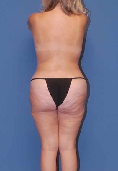 Abdominoplasty Before & After