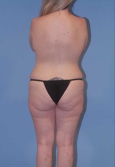 Abdominoplasty Before & After