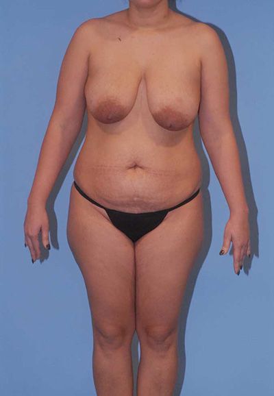Abdominoplasty Before & After