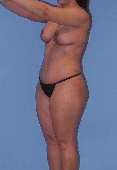 Abdominoplasty Before & After
