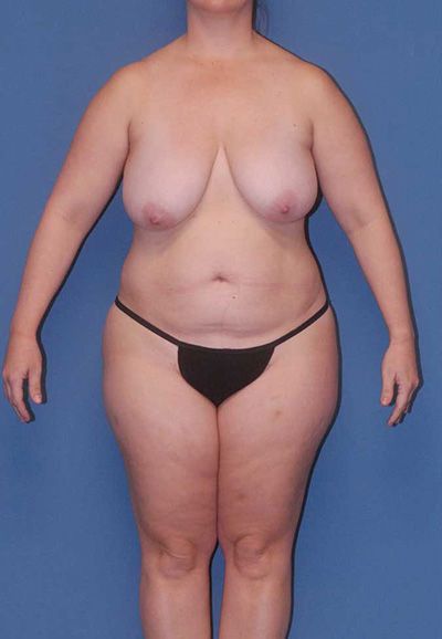 Abdominoplasty Before & After