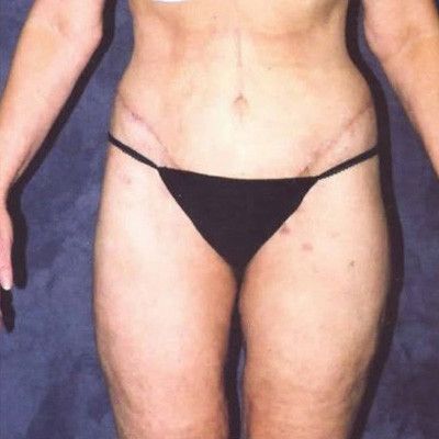 Abdominoplasty Before & After