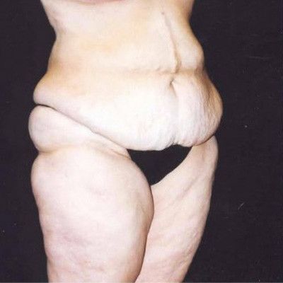 Abdominoplasty Before & After