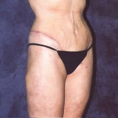 Abdominoplasty Before & After