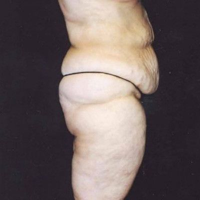 Abdominoplasty Before & After