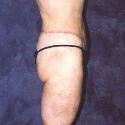 Abdominoplasty Before & After