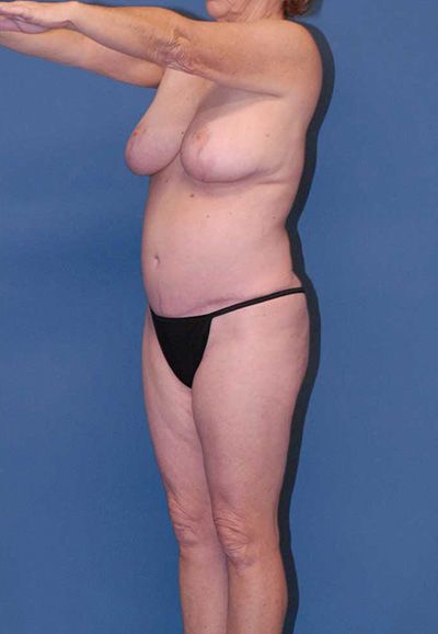 Abdominoplasty Before & After