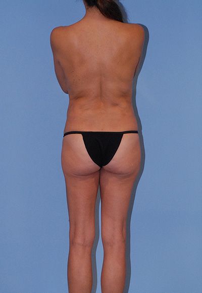 Abdominoplasty Before & After