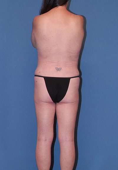 Abdominoplasty Before & After