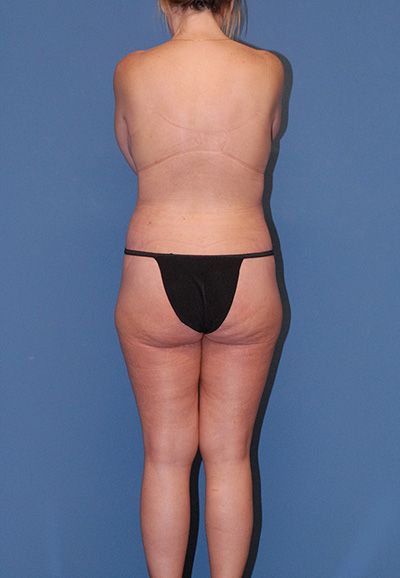 Abdominoplasty Before & After