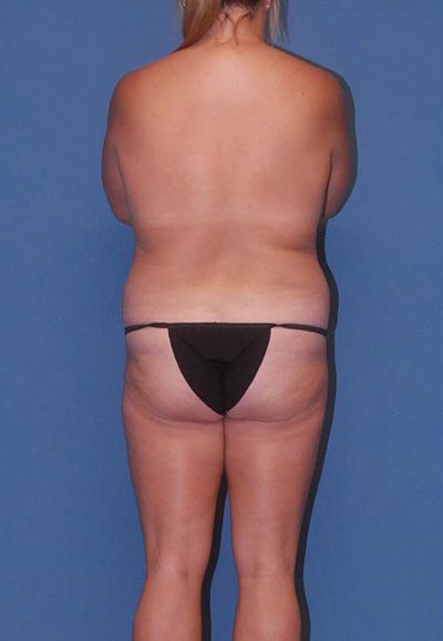 Abdominoplasty Before & After