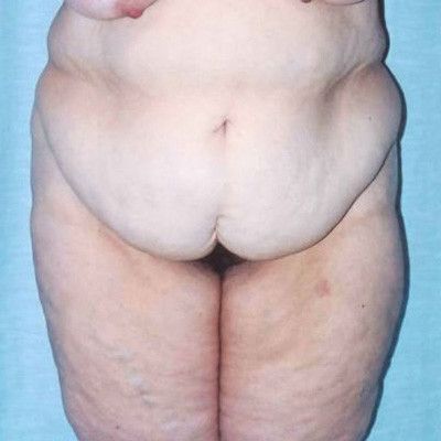 Abdominoplasty Before & After