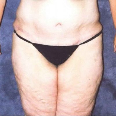 Abdominoplasty Before & After