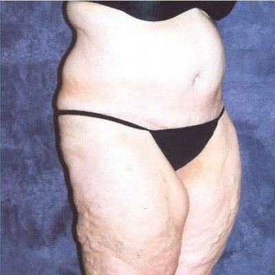 Abdominoplasty Before & After