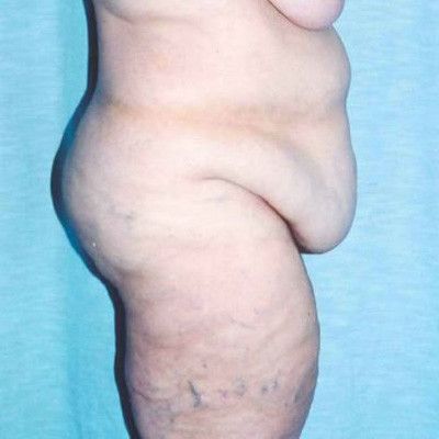 Abdominoplasty Before & After