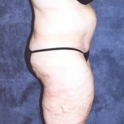 Abdominoplasty Before & After
