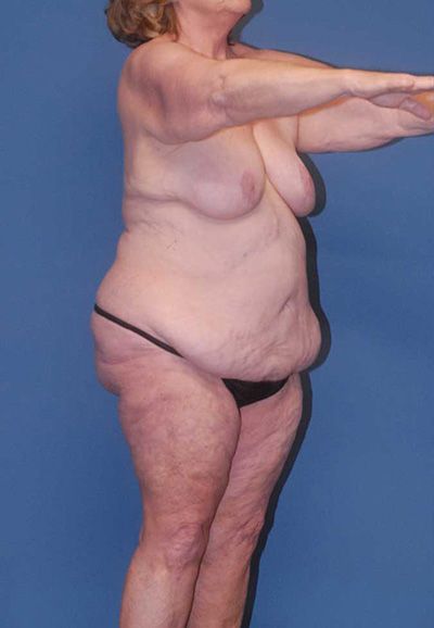 Abdominoplasty Before & After