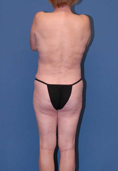 Abdominoplasty Before & After