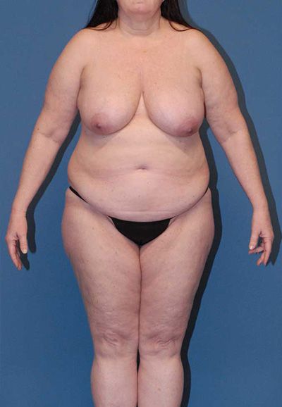 Abdominoplasty Before & After