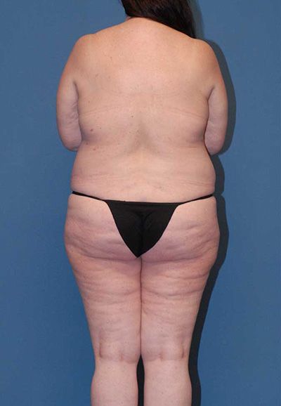 Abdominoplasty Before & After