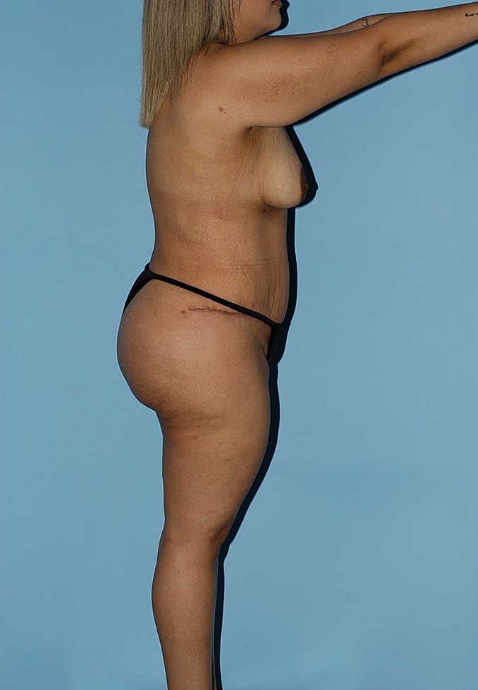 Abdominoplasty Before & After
