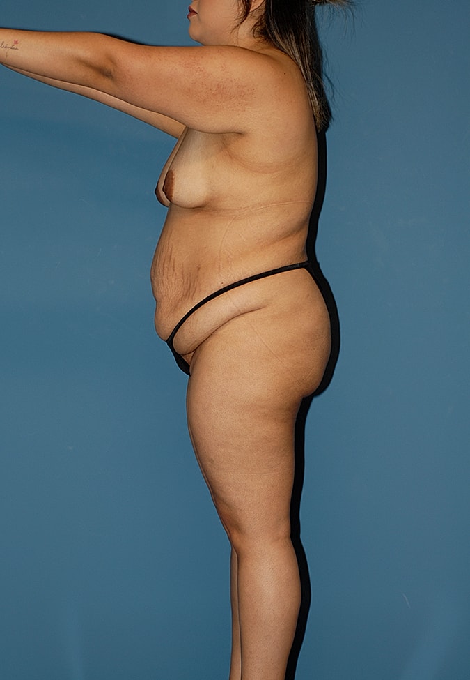 Abdominoplasty Before & After