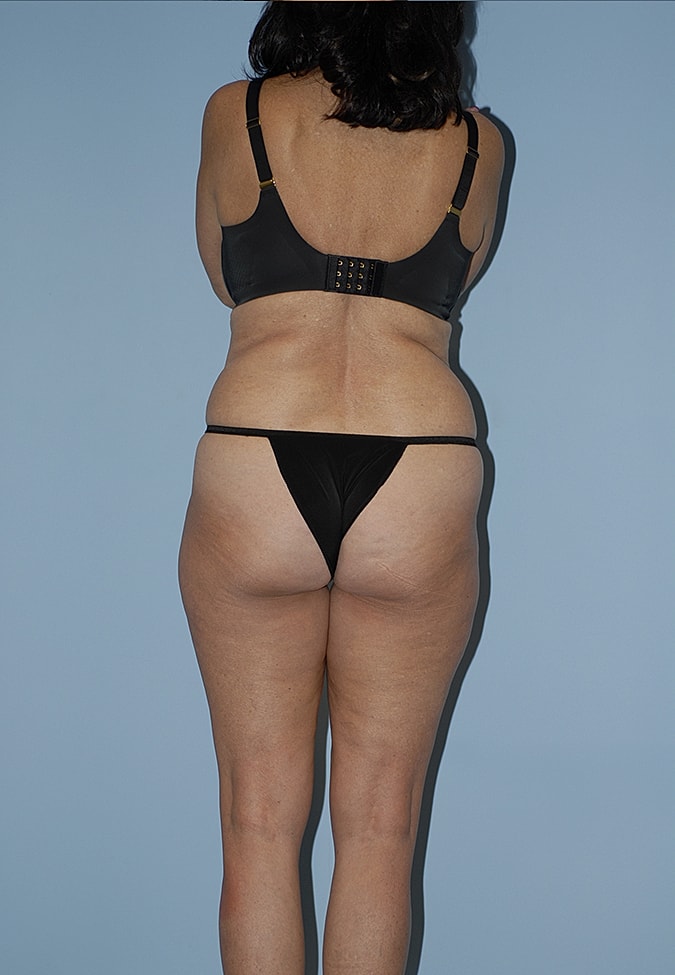 Abdominoplasty Before & After