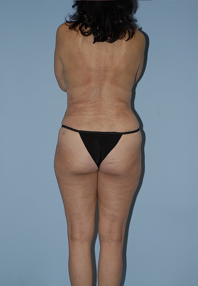 Abdominoplasty Before & After