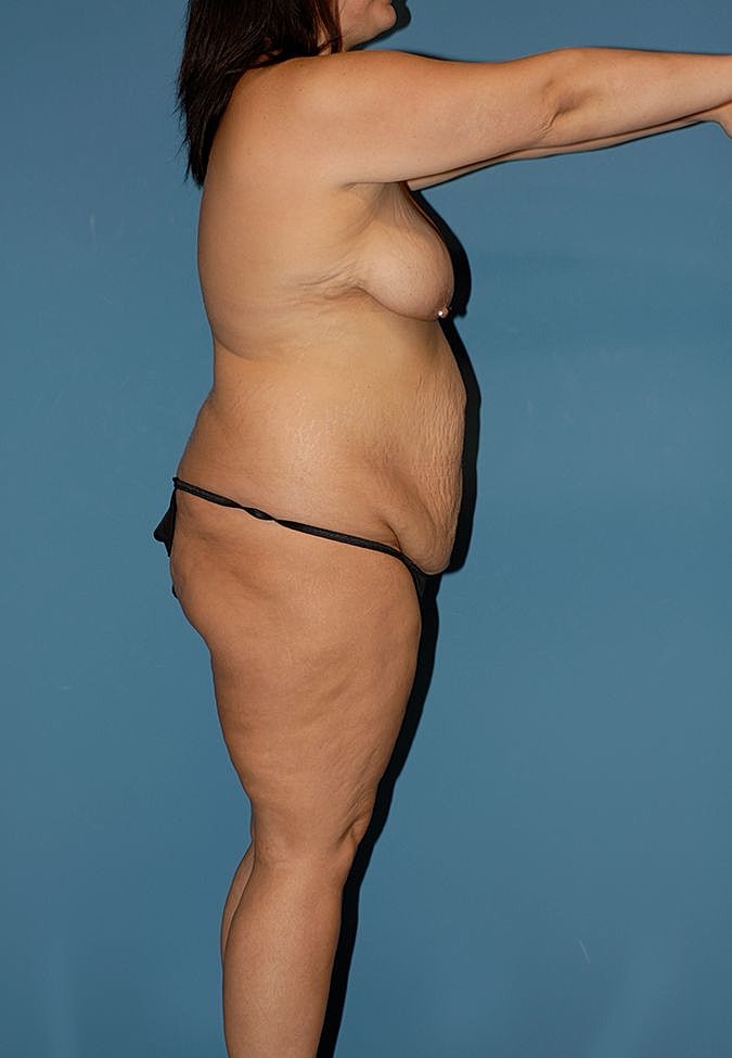 Abdominoplasty Before & After