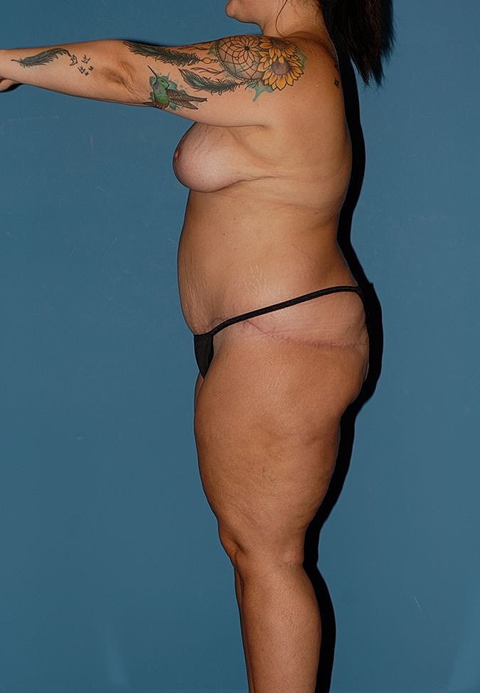 Abdominoplasty Before & After