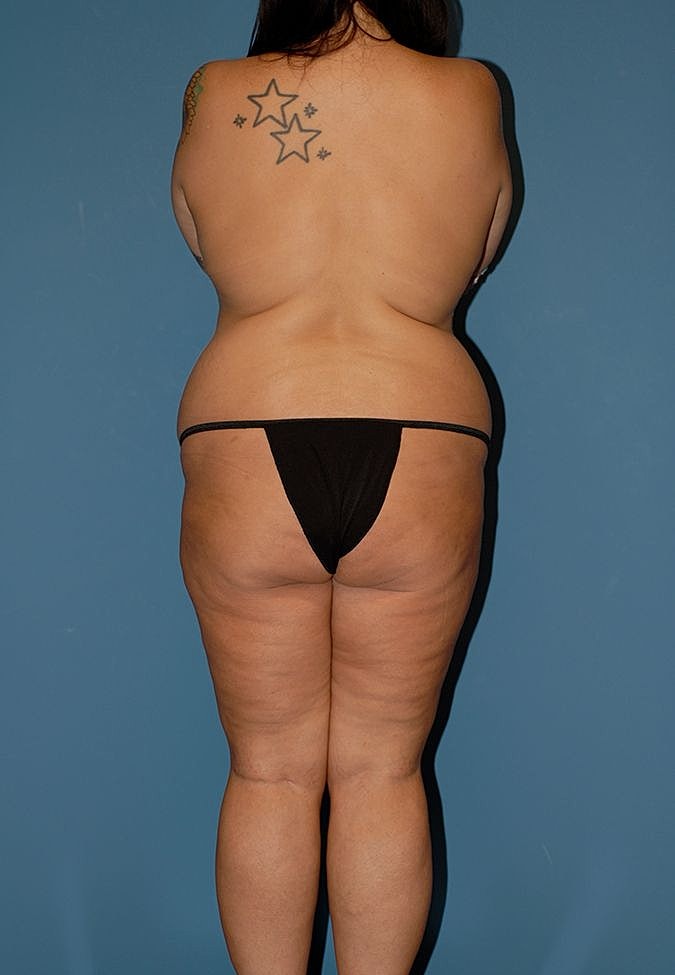 Abdominoplasty Before & After