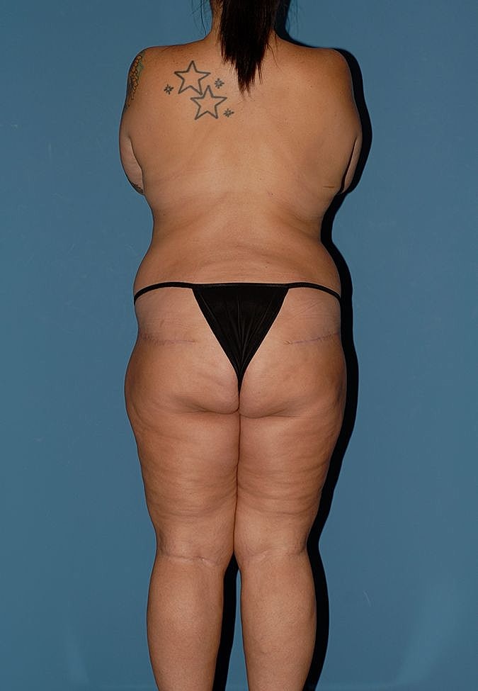 Abdominoplasty Before & After