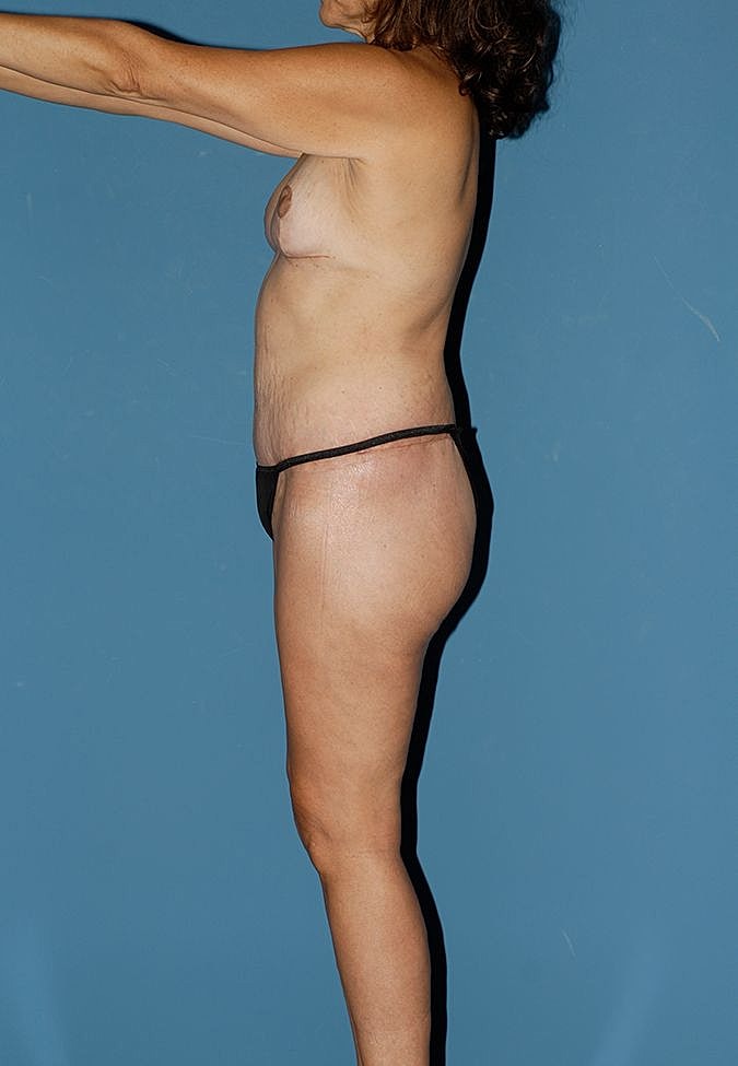 Abdominoplasty Before & After
