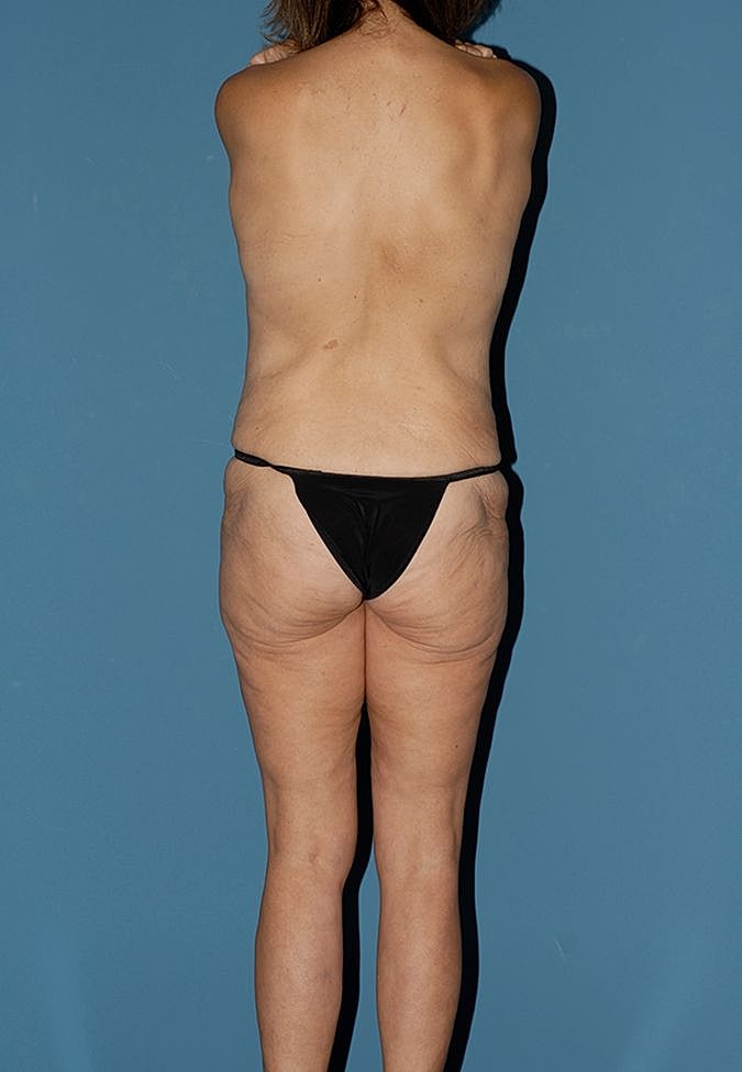 Abdominoplasty Before & After
