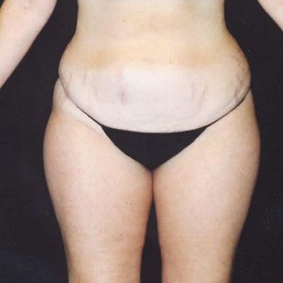 Abdominoplasty Before & After