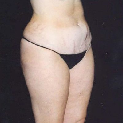 Abdominoplasty Before & After