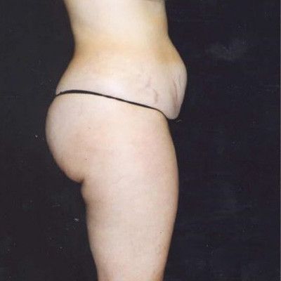 Abdominoplasty Before & After