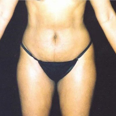 Abdominoplasty Before & After