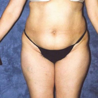 Abdominoplasty Before & After