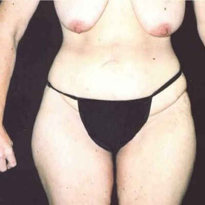 Abdominoplasty Before & After