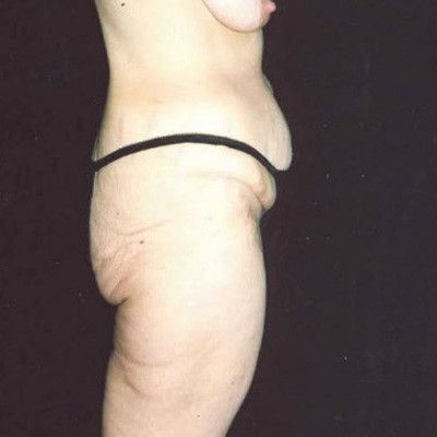 Abdominoplasty Before & After