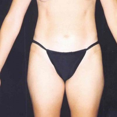 Abdominoplasty Before & After