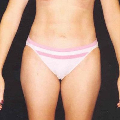 Abdominoplasty Before & After