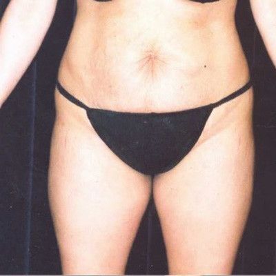 Abdominoplasty Before & After