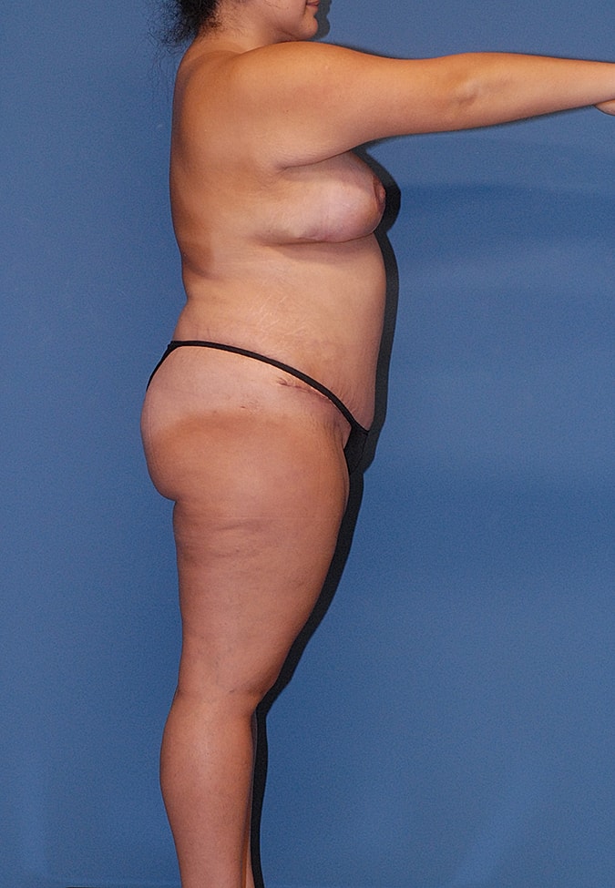 Abdominoplasty Before & After