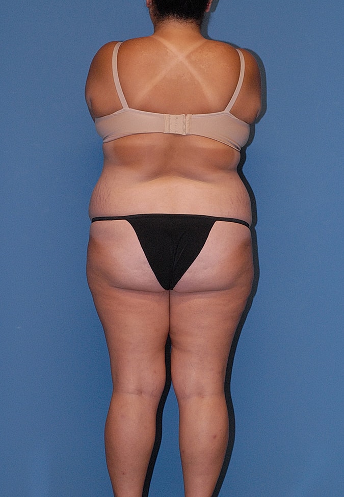 Abdominoplasty Before & After