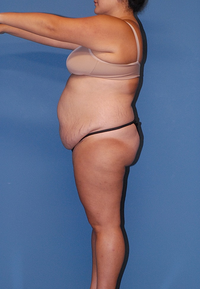 Abdominoplasty Before & After