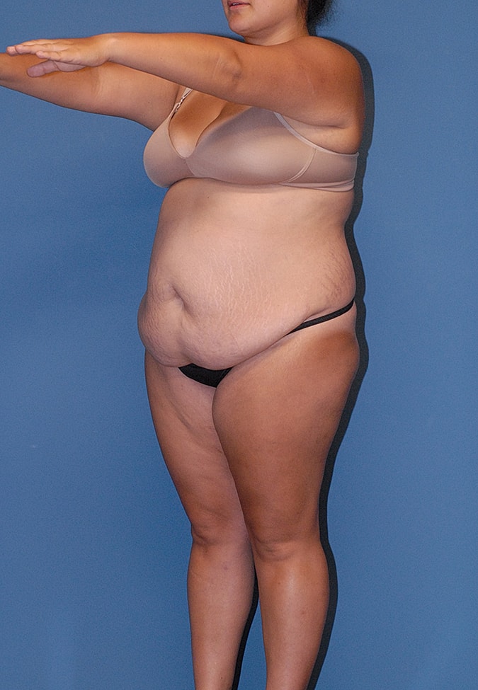 Abdominoplasty Before & After