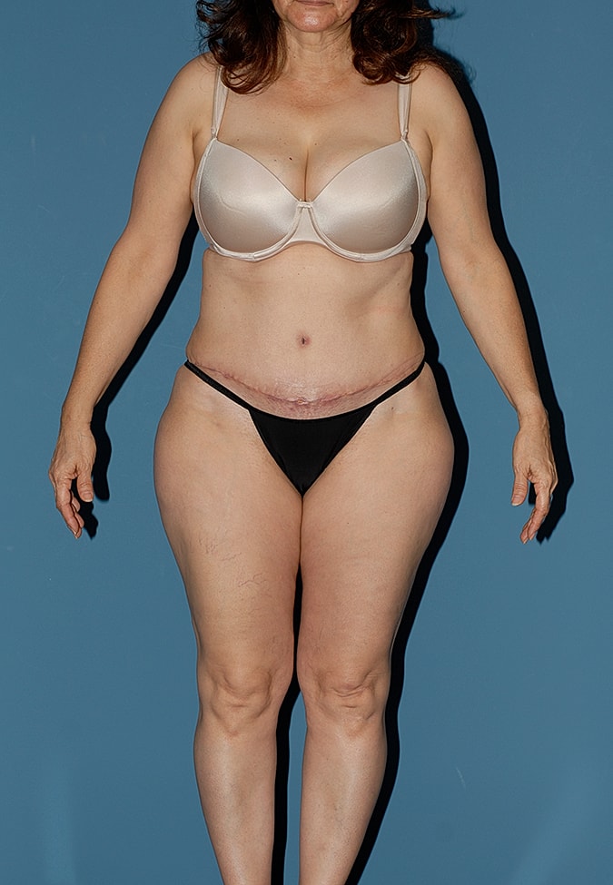 Abdominoplasty Before & After