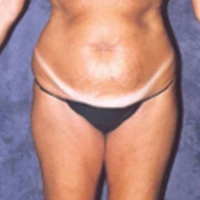Abdominoplasty Before & After
